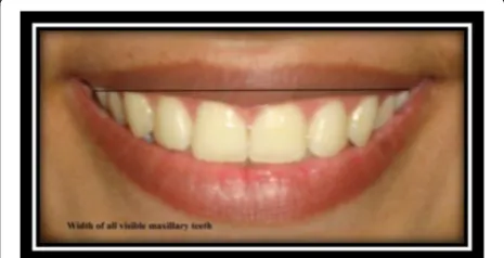Fig. 11 Smile width