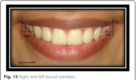 Fig. 13 Right and left buccal corridors