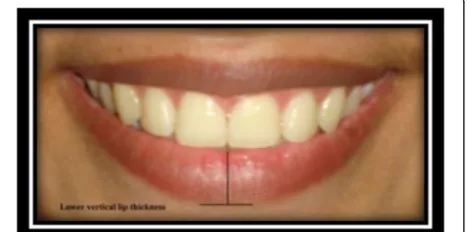 Fig. 17 Upper vertical lip thickness