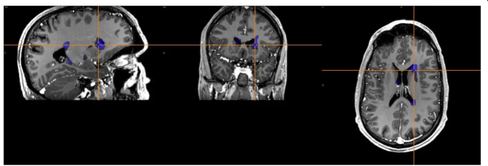 Figure 1 Postoperative magnetic resonance images for the targets of bilateral Globus Pallidus Pars Interna from a representativepatient