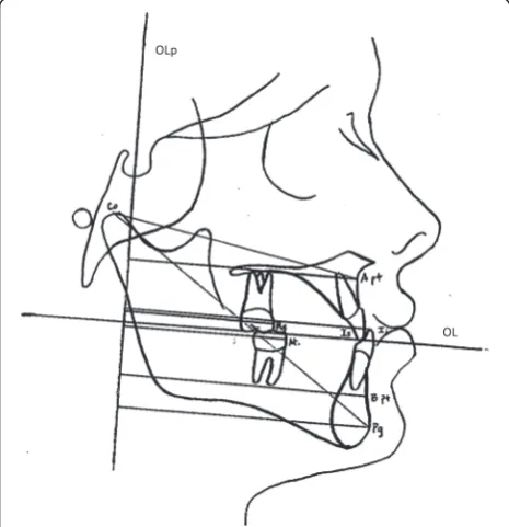Fig. 3 Landmarks used in vertical measurements. Vertical changes of Apoint was measured from the occlusal plane parallel (OLp); maxillaryincisal and molar changes were measured from the palatal plane;mandibular incisor and molar changes were measured from themandibular plane