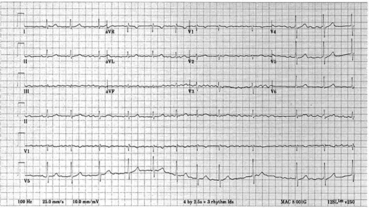 Figure 1 Electrocardiogram showing atrial ﬁbrillation with a controlled rate of ventricular response