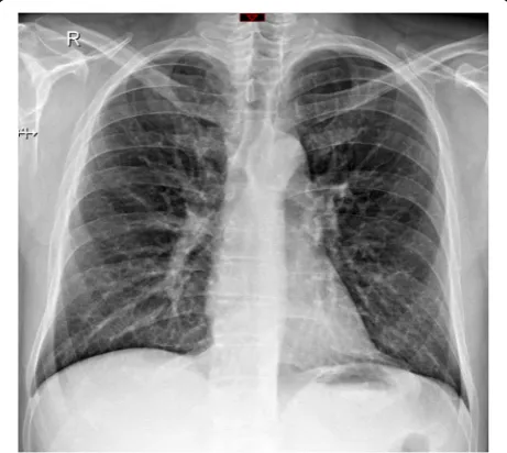 Fig. 4 Sixty-nine-year-old man admitted at the intensive care unitwith dyspnea. Axial chest computed tomography demonstratesground-glass opacities with peribronchovascular distribution
