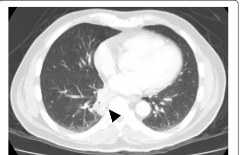 Fig. 2 Arrow: Osteolytic lesion with a soft tissue component atthe sternum