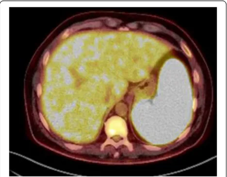 Fig. 1 FDG-PET/TC. FDG-PET scans shows diffuse high uptake in thespleen (SUV máx: 13.26), liver, and bone marrow