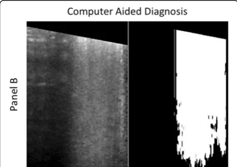 Fig. 4 Left: involvement of about half of the pleural line, difficult tobe objectively quantified by the eye