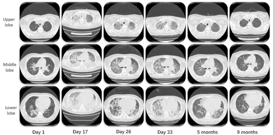 Fig. 1 Chest computed tomography (CT) on day 1, day 17, day 26 and day 33 and followed up after 5 months and 9 months