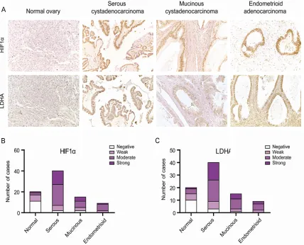 Figure 1. HIF-1α and LDHA expression are commonly up-regulated in ovarian cancer tissues