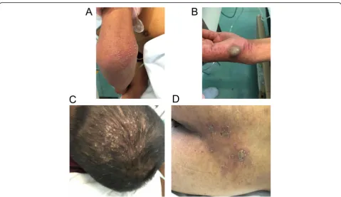 Fig. 1 Skin manifestations of RBF on the right elbow (a), right palm (b), head (c) and hip (d) upon admission