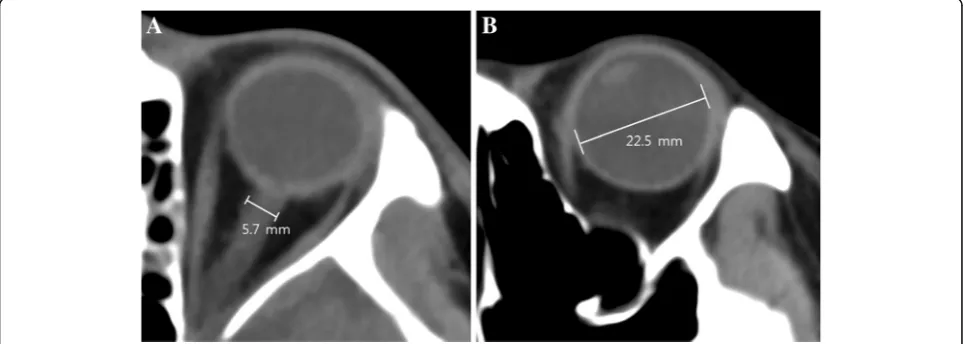 Fig. 2 Measurement of optic nerve sheath diameter (a) and eyeball transverse diameter (b) on the brain computed tomography scan