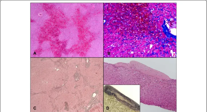 Fig. 2 Common histologic features of SOS. a Shown are changes typical of sinusoidal obstruction (Case 12)