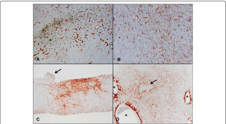 Fig. 3 Aberrant expression of CD34, SMA, and GS in cases with sinusoidal obstruction syndrome were used to calculate the CSI score