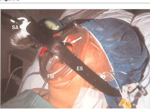 Figure 2aemic patients. Even though good cooperation of thepatient and thorough monitoring of vital functions are