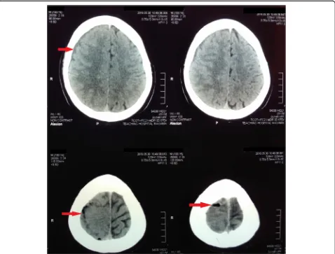 Fig. 1 Pre-treatment non-contrast computed tomography of brain showing a right fronto-parietal subdural collection with gas locules