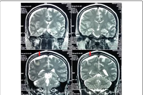 Fig. 2 Pre-treatment T2-weighted MRI brain (coronal view) showing a subdural collection in the right fronto-temporo-parietal region withpossible abscess formation in the right parietal region