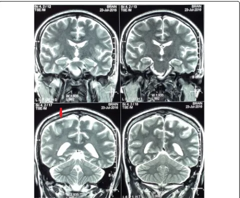 Fig. 3 Post-treatment T2-Weighted MRI brain (coronal view) showing resolution of the subdural collection