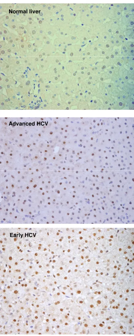 Figure 1Expression of CDK inhibitor p27Expression of CDK inhibitor p27. Immunohistochemistry of p27 in normal liver and chronic HCV-infected liver with Early and Advanced HCV