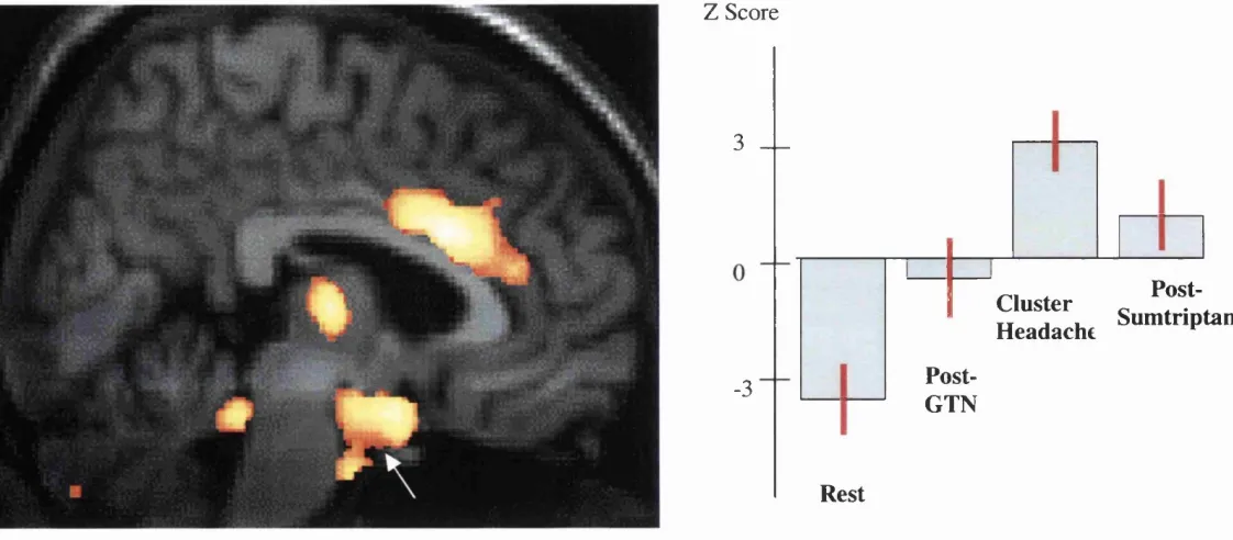Figure 7.2Activation of structures involved in pain processing and of the intracranial vessels