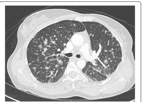 Fig. 1 Imaging characteristics from lung CT. A 46-year-old womanwas admitted to the ICU for acute respiratory failure