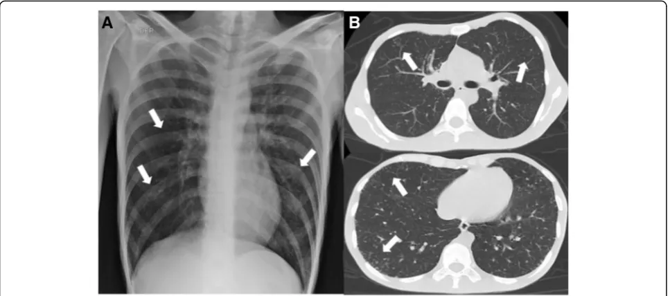 Fig. 2 Patient images showing random distribution of micro-nodular opacities. a. Chest X-ray