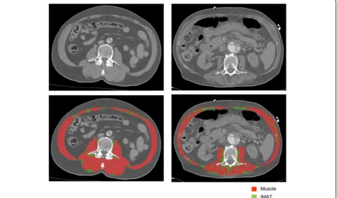 Fig. 1 Example of CT scan analysis. This image shows CT scans at the level of lumbar vertebra 3 of two patients both un-analysed (upper row)and analysed (lower row)