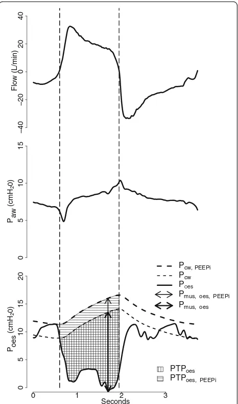 Fig. 1 Graphic illustration of flow, airway pressure (product (between Precoil pressure (Paw), and oesophagealpressure tracing (Poes) during proportional assist ventilation