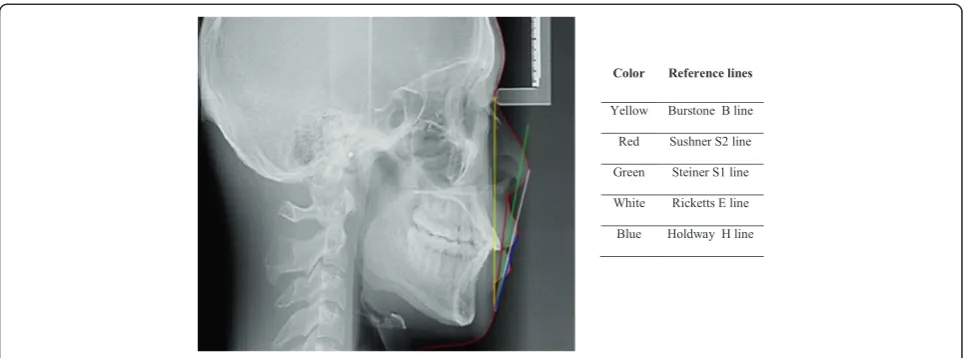 Figure 1 Lateral cephalometric radiograph representing the five reference lines.