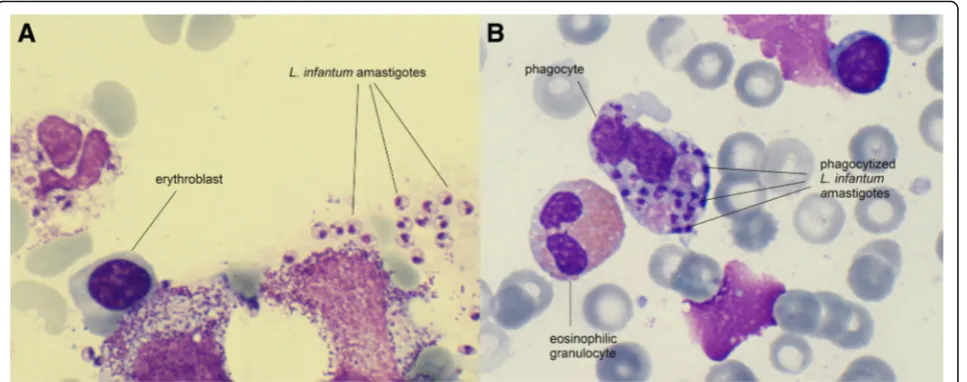 Fig. 1 Haematoxylin and eosin stained bone marrow aspirate of the 18-months-old twin (case 1) showing extra- (a) and intracellular (b)Leishmania amastigotes