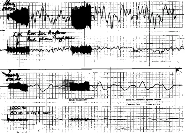 Figure  1. Summated evoked response and raw EEG tracings indicating the  difference  in the EEG tracings when auditory stimuli are perceived in the right  and left  ears