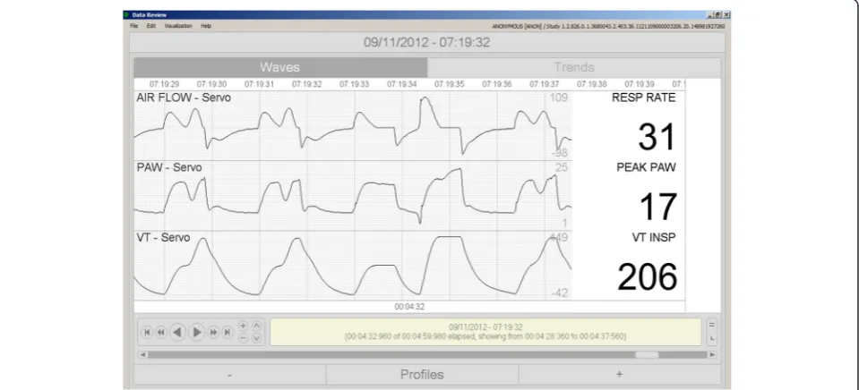 Fig. 1 Irregular traces from a patient in PC-CMV. A second inspiratory peak flow in a machine-triggered breath strongly suggests reverse triggering