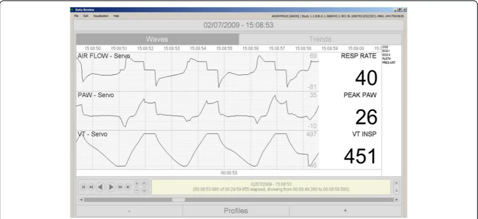 Fig. 2 The airway pressure alarm aborts inspiratory cycles, producing highly variable inspiratory times and volumes and making it difficult for thesystem to correctly identify the mode as VC-CMV
