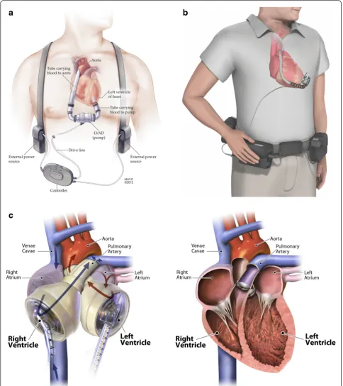 Fig. 2 Most commonly used mechanical circulatory support devices. a The HeartMate II LVAD (Thoratec Corp.)