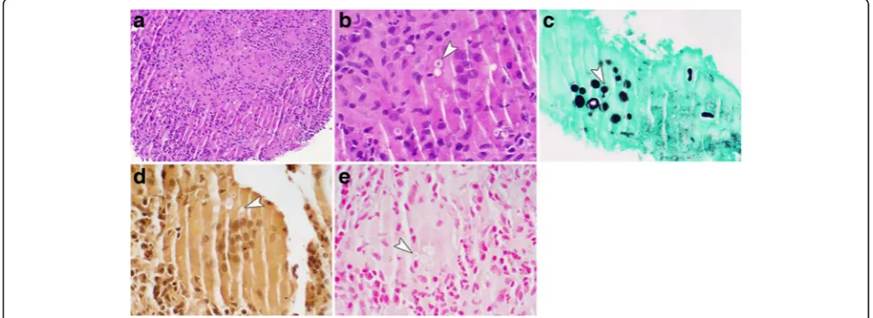 Fig. 2 Photomicrographs from the left upper lobe mass following resection. a Non-necrotizing granulomatous inflammation with visibleintracellular yeast
