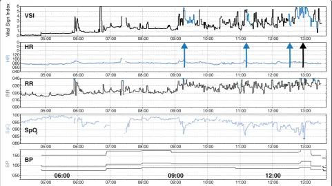Fig. 1 Screen display of physiologic data stream of a patient with progressive decompensation to overt cardiorespiratory insufficiency over 6 h.Blue arrows mark times when the fused instability index (vital signs index [VSI]) exceeds “normal” and the black