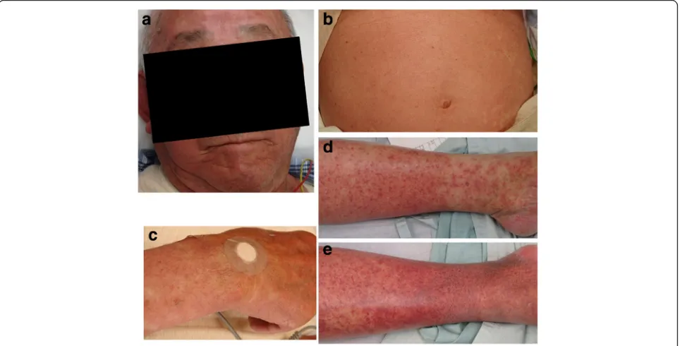 Fig. 1 The patient had generalized erythema that was present on his face (a), trunk (b), right hand (c), left lower leg (d), and right lower leg (e)