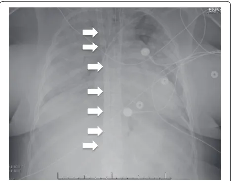 Fig. 1 Veno-venous cannulation for ARDS. This chest X-raydemonstrates severe airspace disease in a patient with ARDS.The dual-lumen ECMO cannula (arrows) can be seen passing throughthe internal jugular vein, superior vena cava, and terminating in theinferior vena cava at the level of the hepatic vein