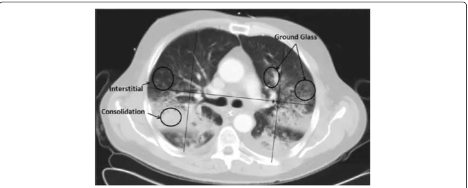 Fig. 4 Example of radiologist’s score findings in chest computed tomography scan slice [34]