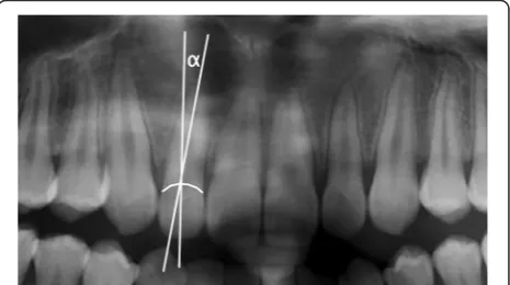 Figure 1 Angle “α” was used to measure mesio-distal crown toroot angulation of the lateral incisors.