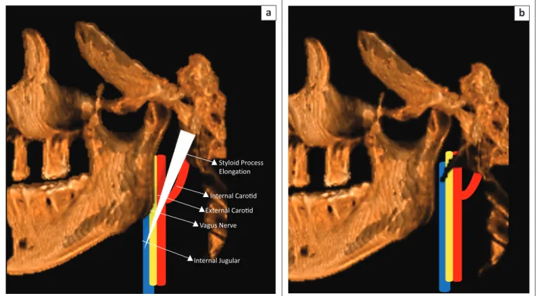 FIGURE 1: Schematic representation of (a) elongated styloid process causing impingement on vital structures versus (b) normal styloid process.