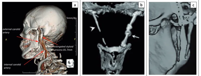 FIGURE 4: Various three-dimensional CT reconstruction images depicting elongation of the styloid process