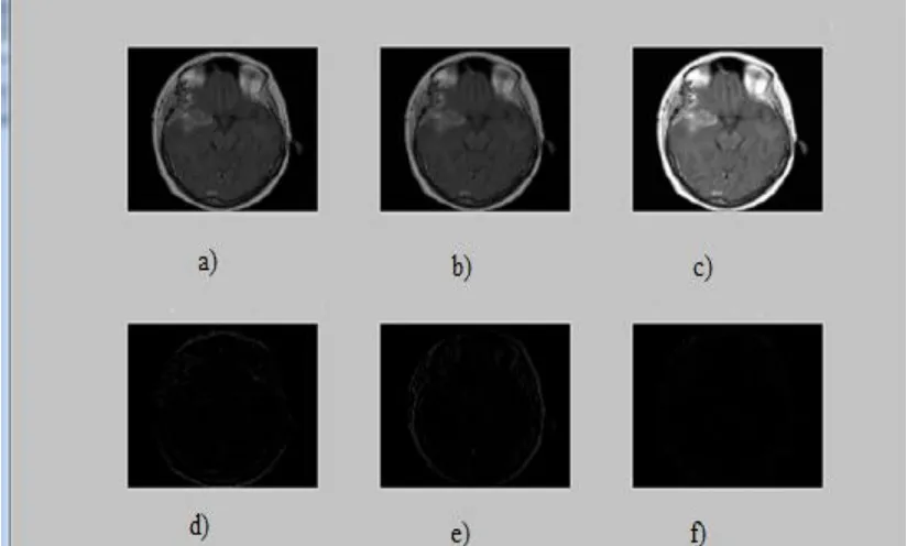 Fig. 4: Tumor detection a) skull detection and b) finding tumorous position 