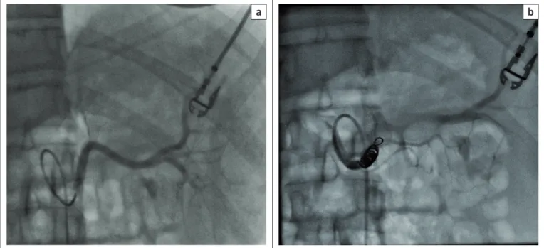 FIGURE 1: Fluoroscopic images demonstrating: (a) angiography of the main splenic artery and (b) coil embolisation of the proximal main splenic artery.