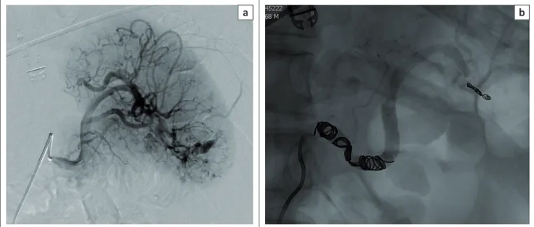 FIGURE 3: Fluoroscopic images demonstrating: (a) angiography of the main splenic artery showing pseudoaneurysm and arteriovenous fistula formation in the lower pole  of the spleen and (b) combined distal and proximal coil embolisation.