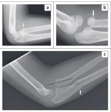 FIGURE 17: (a) Lateral and (b) oblique images of a four-year-old with a radial neck  fracture  (arrows)