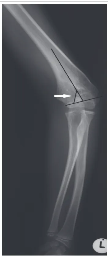 FIGURE 9: (a) AP and (b) Lateral views in a one-month-old with a swollen elbow  who  died  soon  after  admission