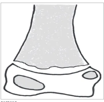FIGURE 14: Intercondylar fracture that extends sagittally to the articular surface  (black and white arrow) splitting the medial and lateral condyles (white arrows).