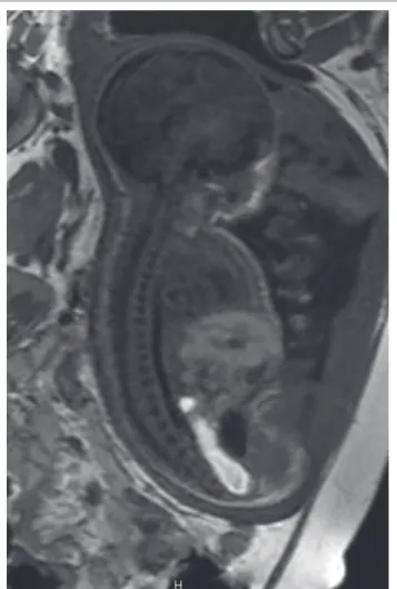 FIGURE 3: Midline sagittal T1W fetal MRI demonstrating a dilated rectum with  some areas of T1W hypointensity in the central rectum representing mixing of  meconium and urine.