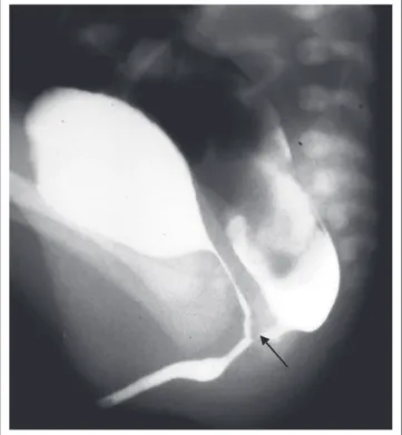 FIGURE 8: Lateral radiograph during high-pressure distal colostogram showing a  recto-vesical fistula (arrow).