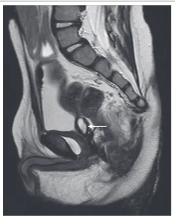 FIGURE  13:  Sagittal  T2W  MRI  of  the  pelvis  showing  a  posterior  urethral  diverticulum (arrow).