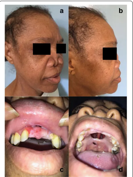 Fig. 1 Clinical presentation of the case. a: Three-quarter picture ofthe face; b: Profile picture of the face; c: Face picture of the faceshowing lack of teeth 11, 21 and 22 which fall spontaneously; d: Bottomview of the face: nasal tip collapse, hard palate lysis and remaining nasalseptum through the hole
